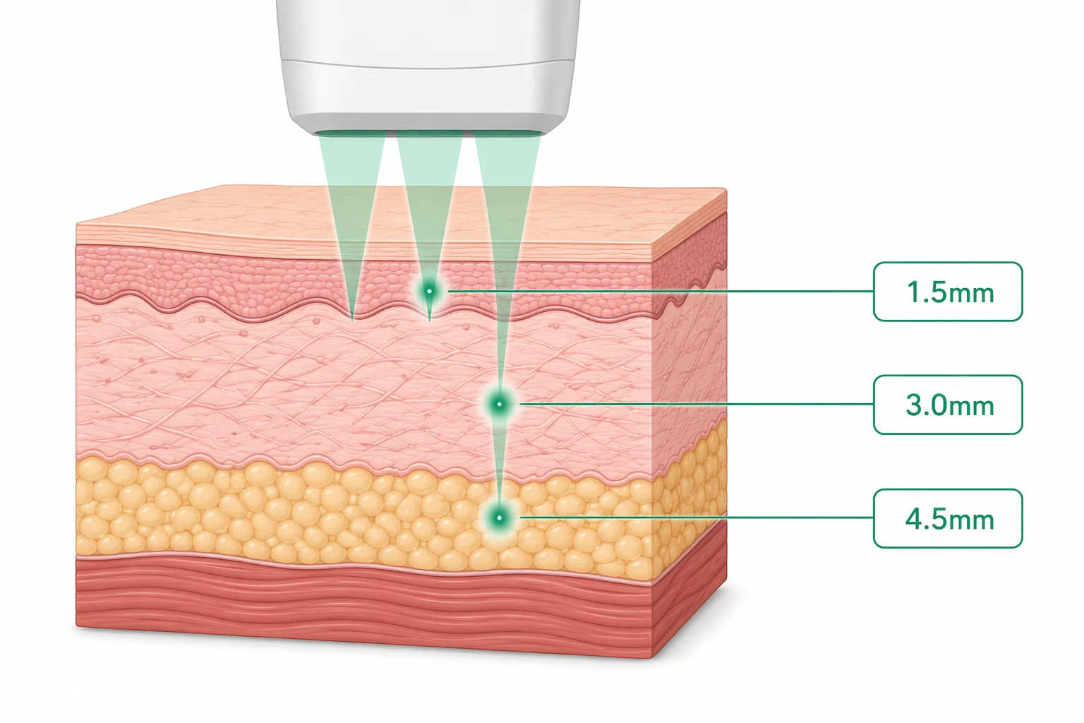 Diagram of fractional laser thermal columns in the epidermis and dermis