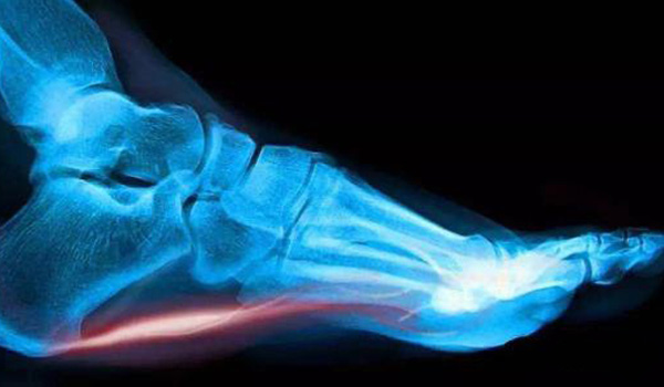 Plantar fasciitis