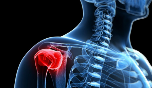 Rotator cuff injury